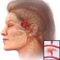 За 24 часа гипертония исчезает бесследно! Медики изумлены...